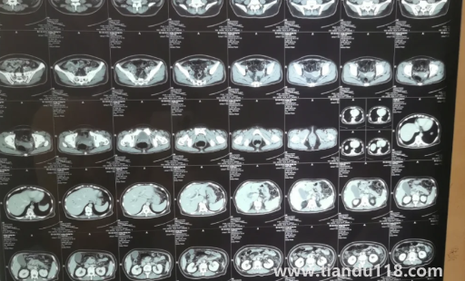 胰腺不舒服早期大便會(huì)變化嗎(胰腺有問(wèn)題會(huì)不會(huì)打嗝)(圖2) 胰腺不舒服早期大便會(huì)變化嗎2